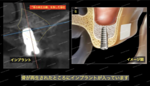 サイナスリフト・骨再生・造成を終えた状態です。白く骨の塊が確認できます